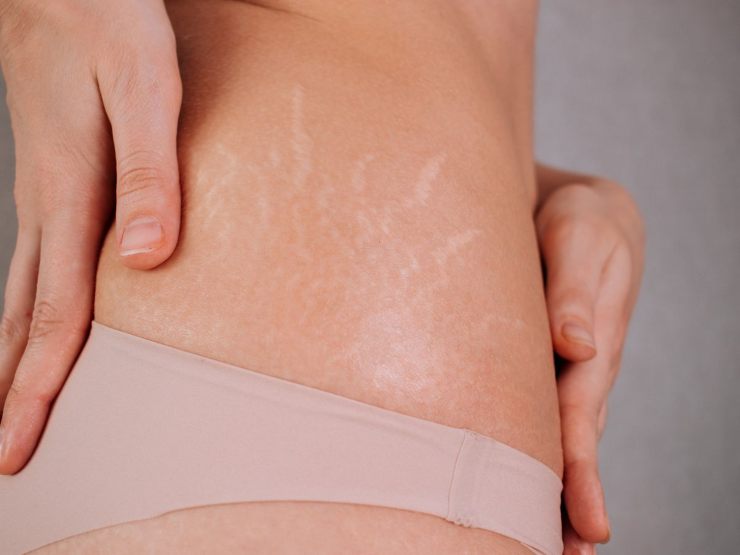 Donna con smagliature sul fianco