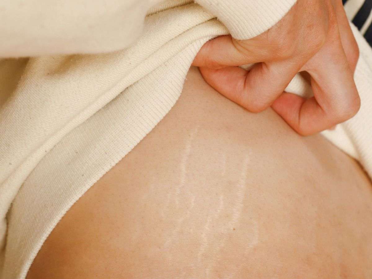 Donna con smagliature sul fianco